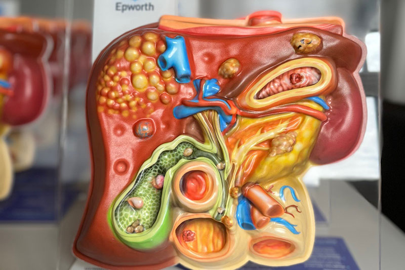 Pancreas models may save a life - Epworth HealthCare
